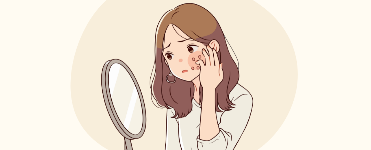 Wat is purging? En waarom lijkt je huid slechter te worden van je nieuwe skincare?