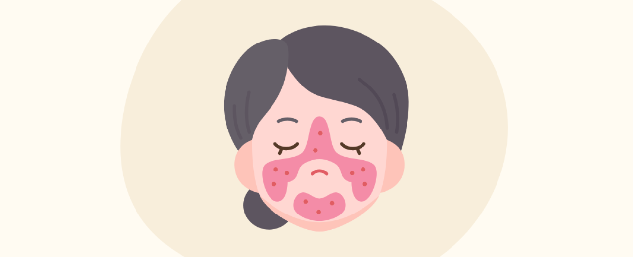 Roodheid behandelen: Een combinatie van IPL en huidversterking