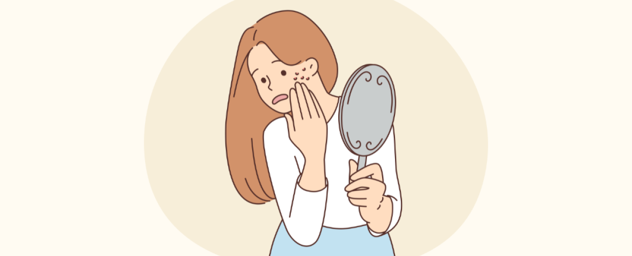 Alles wat je moet weten over acne