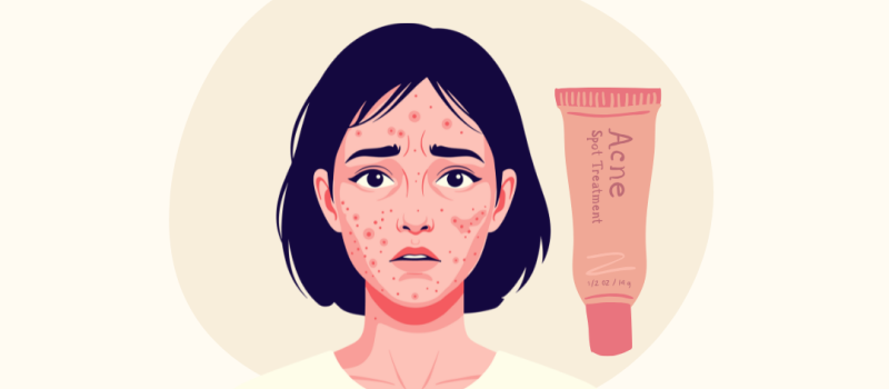 Acne behandelen met antibiotica