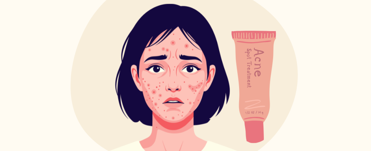 Acne behandelen met antibiotica