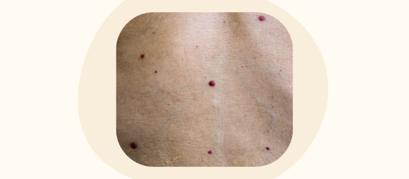 Rode bultjes op de huid: wat zijn dat?
