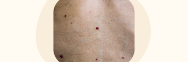 Rode bultjes op de huid: wat zijn dat?