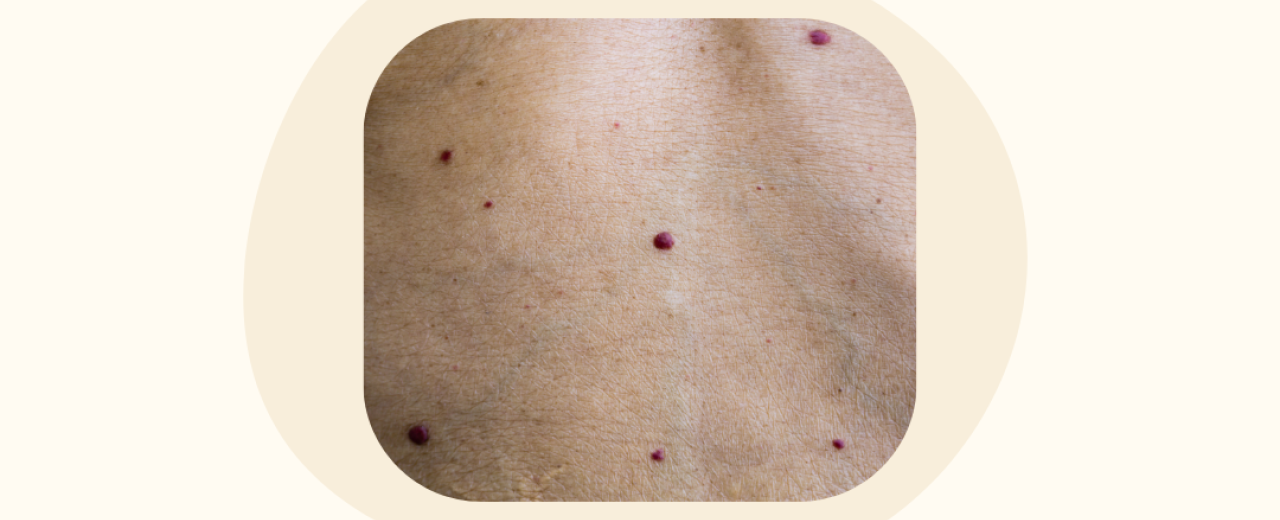 Rode bultjes op de huid: wat zijn dat?