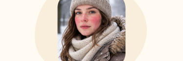 Rosacea in de winter: waarom klachten verergeren en wat je kunt doen
