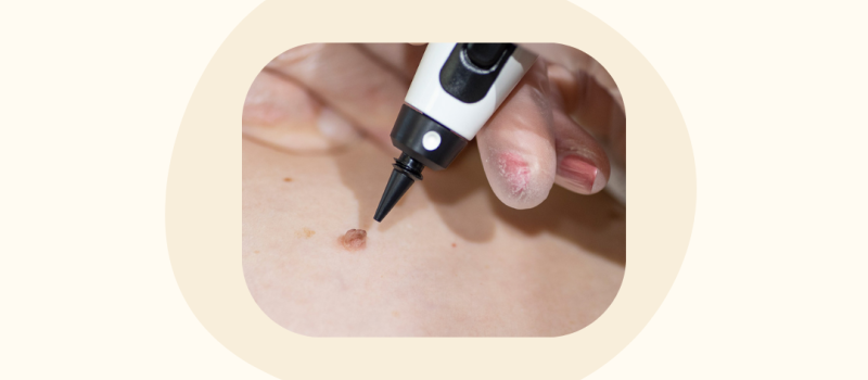 Plekjes en vlekjes verwijderen met de CryoPen