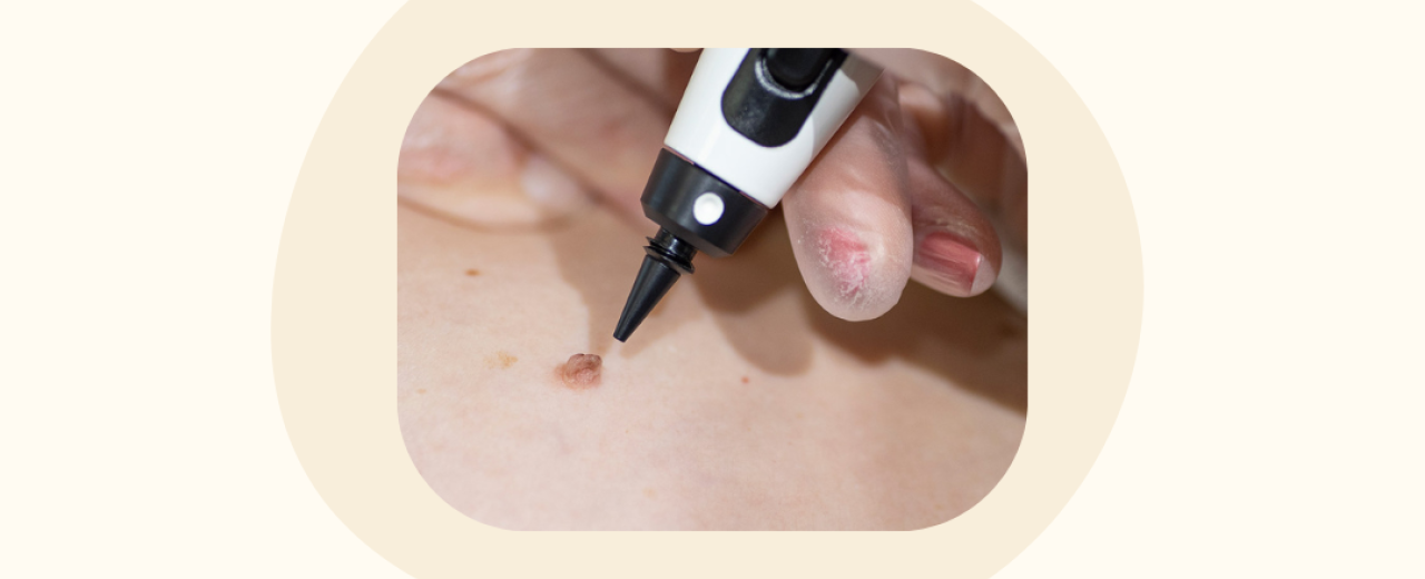 Plekjes en vlekjes verwijderen met de CryoPen