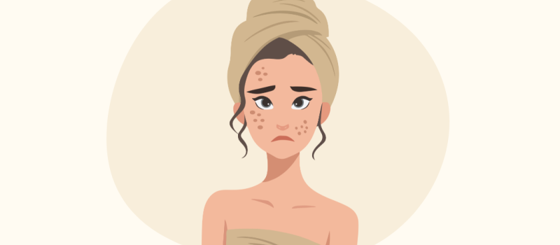 Acne op latere leeftijd: waarom krijg je als volwassene nog acne?