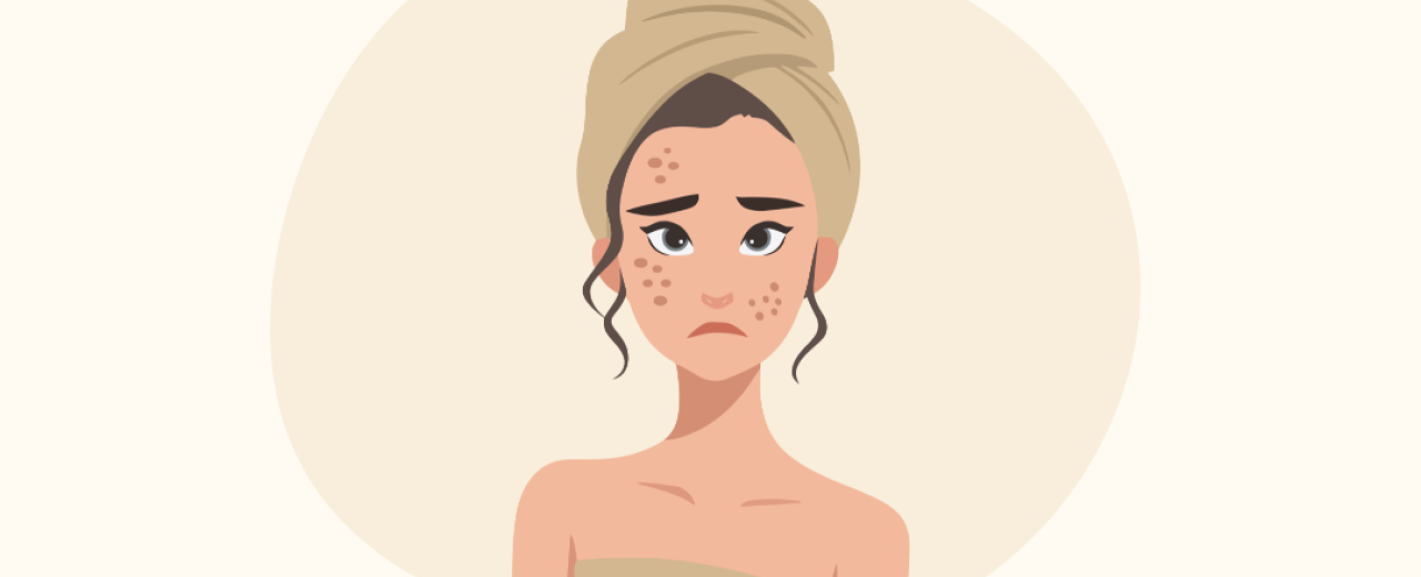 Acne op latere leeftijd: waarom krijg je als volwassene nog acne?